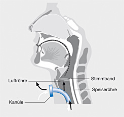 trachealkanüle sekretmanagement